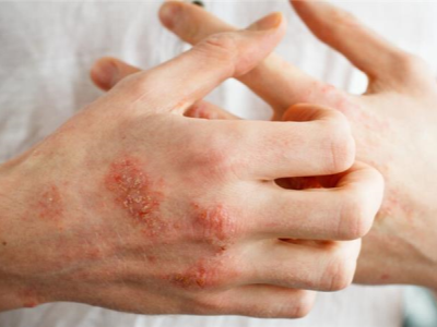 Hand Eczema Treatment