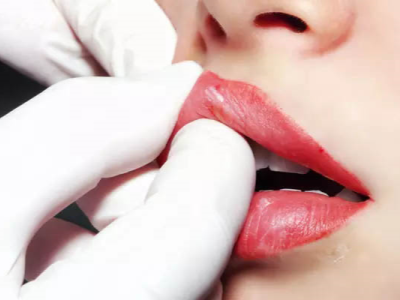 Is Lip Filler Without Needle?