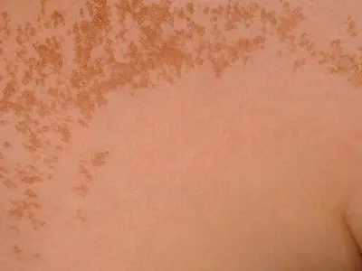 Is Becker's nevus dangerous?