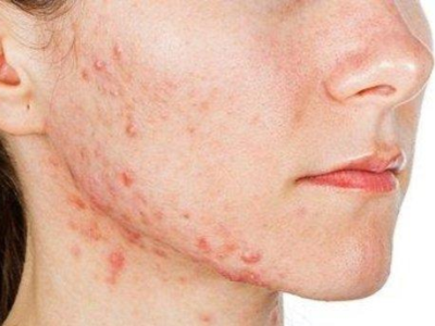 What is cosmetic acne?