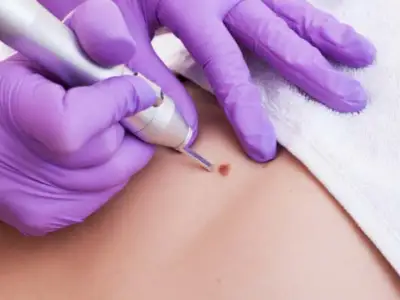 Genital Siğiller HPV Aşısı