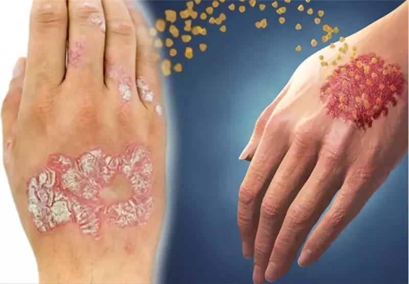 Psoriasis (Sedef Hastalığı) Tedavisi