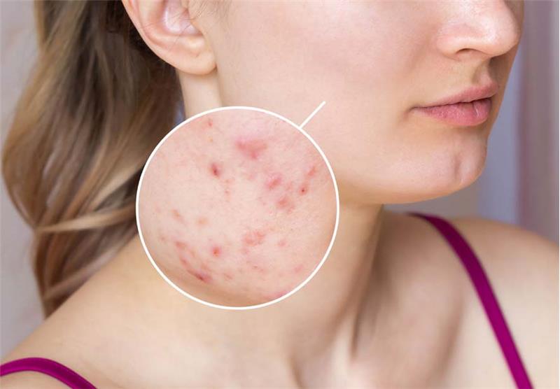 Rosacea Disease Treatment