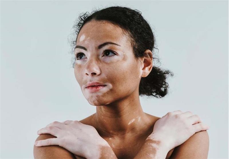 Vitiligo Tedavisi