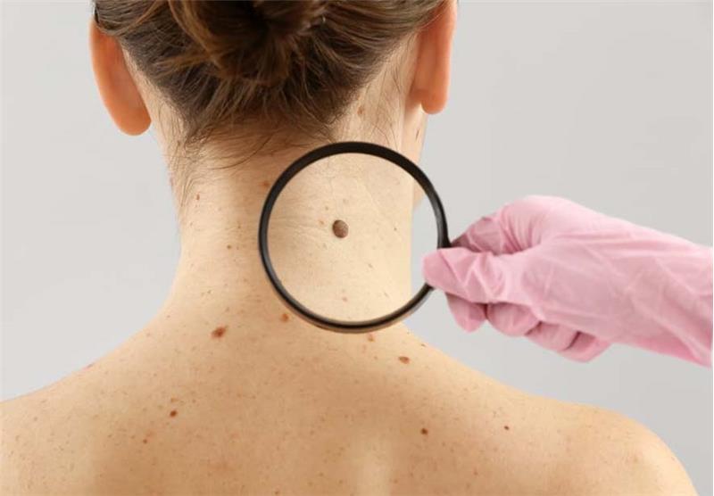 Treatment of Non-Melanoma Skin Cancers