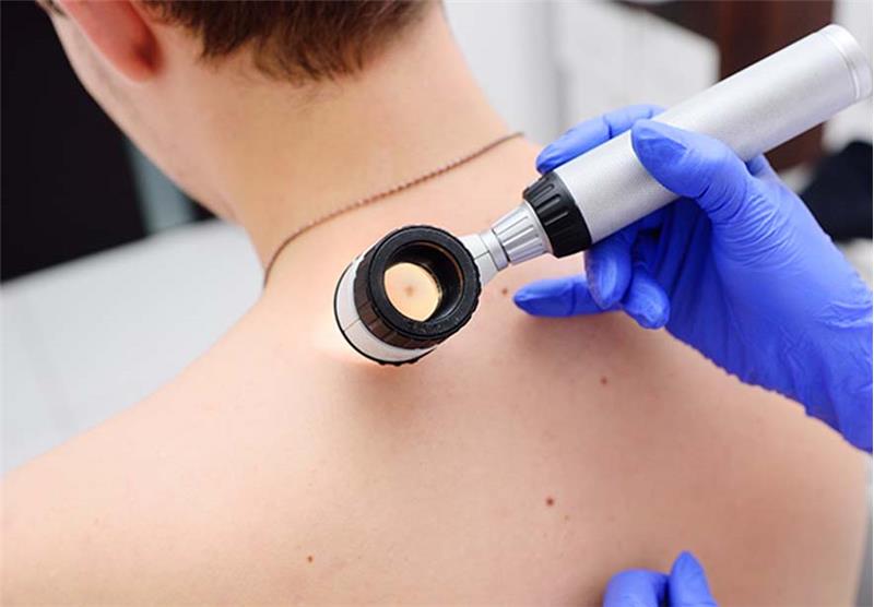 Melanoma Treatment